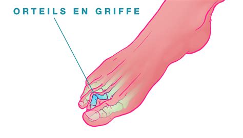 D Finition De L Hallux Valgus Docteur Becquet Nice