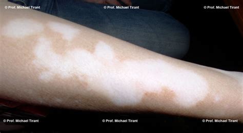 Vitiligo Diagnosis Center Vitiligo Diagnosis And Treatment In Usa