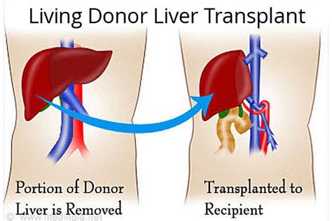 Liver Transplant The Only Hope For Those With Little Hope Of Life Dr