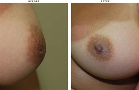 Inverted Nipple Before And After Pictures Dr Turowski Plastic
