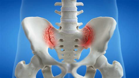 Sacroiliac Joint Injection Northeast Spine And Sports Medicine