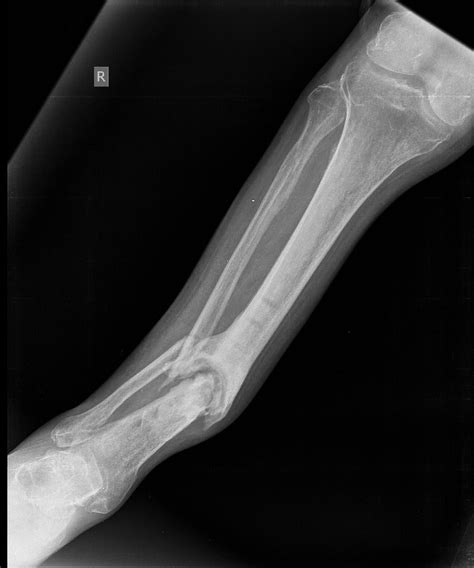 Fracture Non Union And Pseudoarthrosis Buyxraysonline