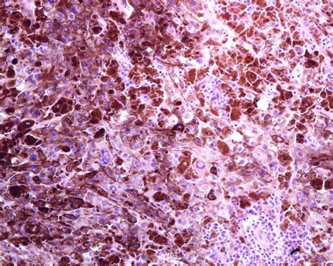 Human Lymph Node Metastasis Of Malignant Melanoma Stock Image Image