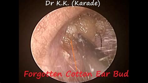 Removal Of Forgotten Stuck Cotton Ear Bud Looks Like Impacted Ear Wax