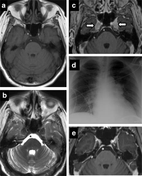 Neuroimaging Of Meckels Cave In Normal And Disease Conditions