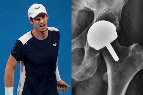 Andy Murray Documentary What We Can Learn About Major Orthopaedic