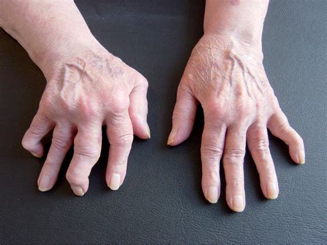 Romatoid Artrit Nedir Neden Olur Diyet Nasıl Olmalıdır