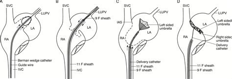 A Novel Method For Transcatheter Closure Of Atrial Septal Defect Within