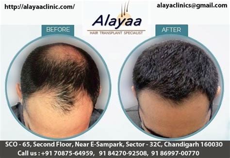 Alayaa Clinic Best Hair Transplant Clinic In Chandigarh