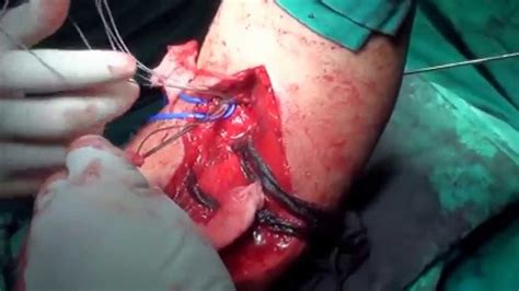 Chronic Biceps Brachialis Tendon Rupture Recostruction