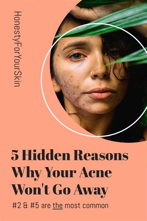Acne Wont Go Away Help These Are The 5 Hidden Reasons Why