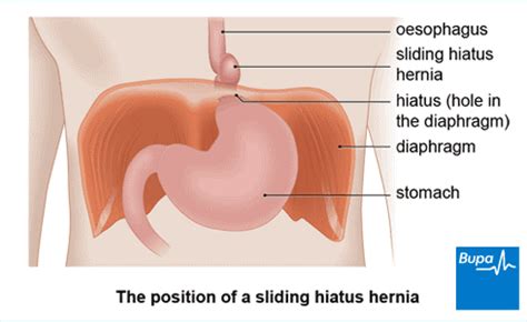 Hiatus Hernia