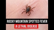 Rocky Mountain Spotted Fever (RMSF) - YouTube