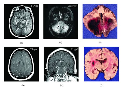 A Flair Mri Sequence Demonstrates Widespread Abnormal Signal In The