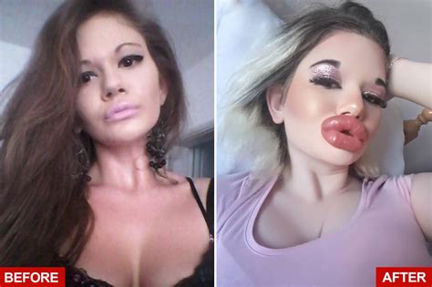 Woman With Worlds Biggest Lips Is Getting More Injections