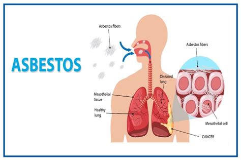 Know All About Asbestosis Find Best Treatment At Medicover