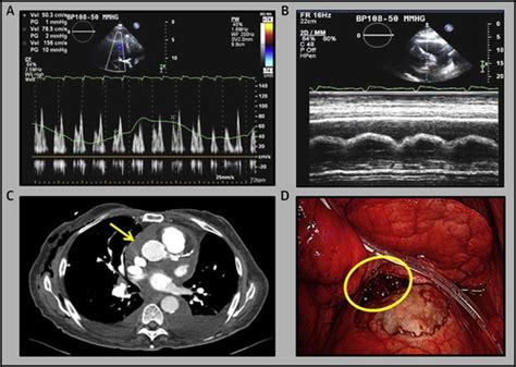 Primary Malignant Pericardial Mesothelioma A Clinical Case Series