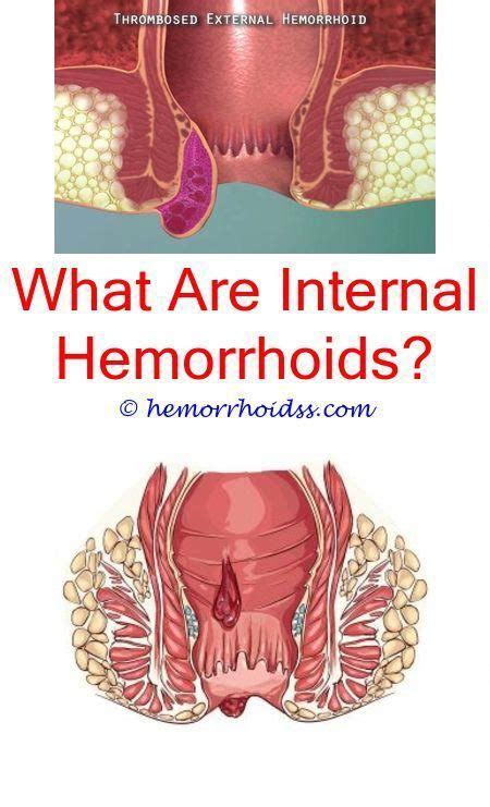 Pin On Hemorrhoids During Pregnancy