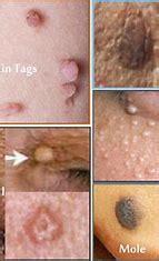 Understanding The Difference Between Genital Warts And Skin Tags Compare