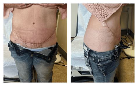 Before After Tummy Tuck Panniculectomy Photos Nevada Surgical