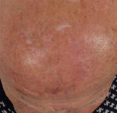 Washington Dc Skin Cancer Before And After Photos Mclean Va Plastic