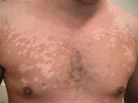 Pityriasis Versicolor Stock Image M Science Photo Library Hot Sex Picture