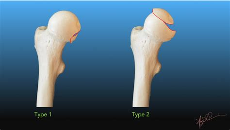 Pipkin Classification Of Femoral Head Fractures Uw Emergency Radiology