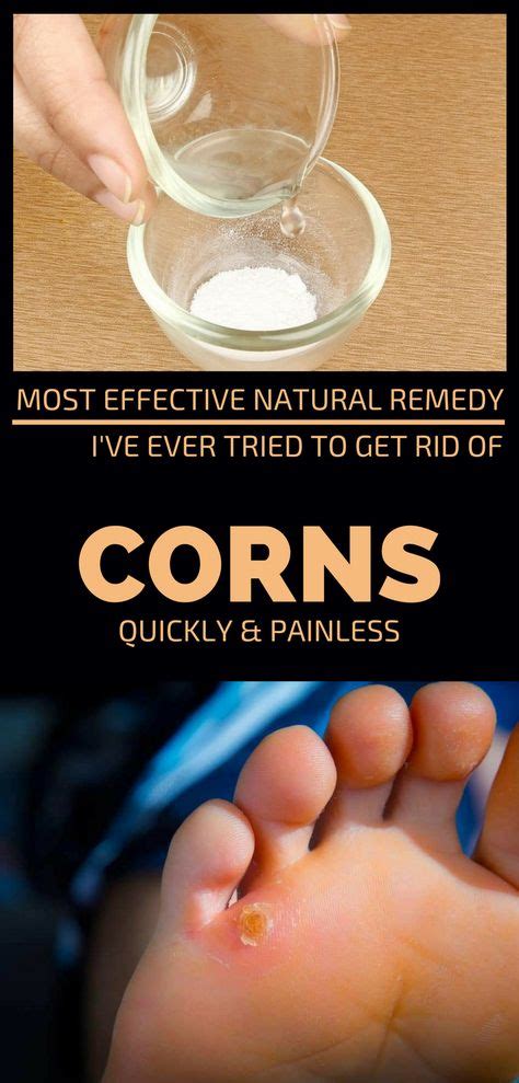 Most Effective Natural Remedy I Ve Ever Tried To Get Rid Of Corns