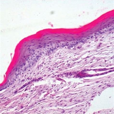 Orthokeratinized Odontogenic Cyst Stratified Squamous Epithelial
