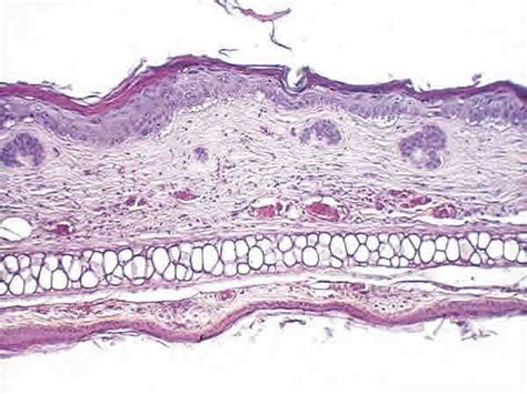 Fig Hiperplasia epidérmica en la oreja con áreas de displasia leve moderada en la piel de
