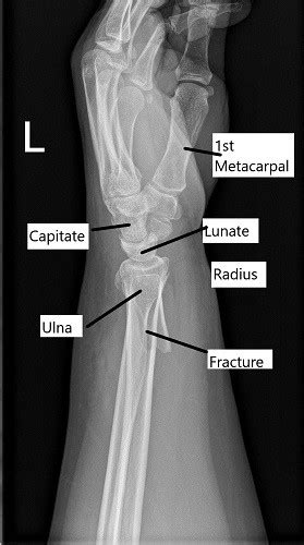 Case Study Distal Radius Fracture In 55 Year Old Male