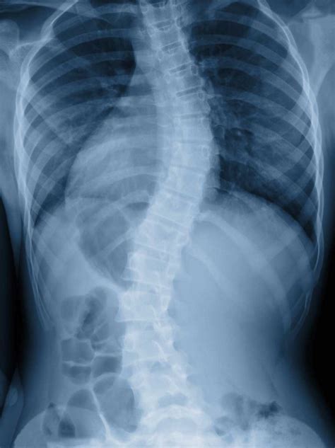 Spinal Scoliosis Curved Spine Scoliosis Specialist Vail Aspen