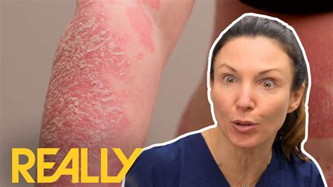 This Is The Worst Case Of Psoriasis That Dr Emma Has Ever Seen The