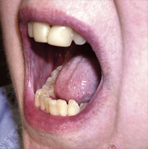 Oral Erosive Lichen Planus Treated With Efalizumab Dermatology Jama