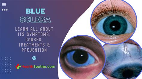 Blue Sclera Symptoms Causes Prevention And Treatment