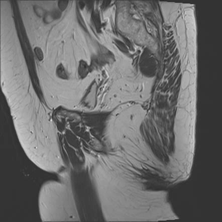 Anterior Rectocele Image Radiopaedia Org