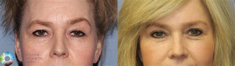 Fox Eye Surgery Before And After Deals Cheapest Save Jlcatj Gob Mx