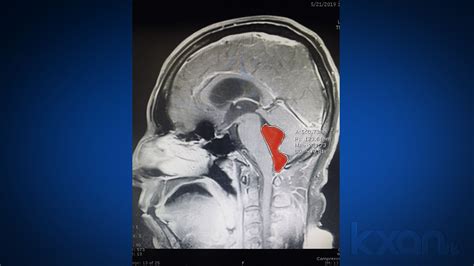 Tapeworm Removed From Texas Mans Brain After Months Of Headaches