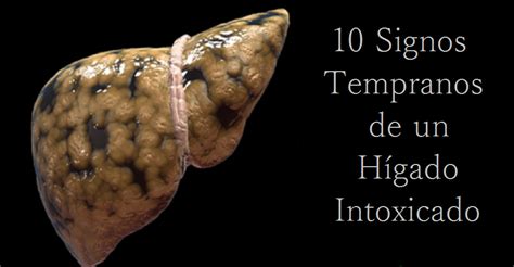 10 Signos Tempranos De Un Hígado Intoxicado