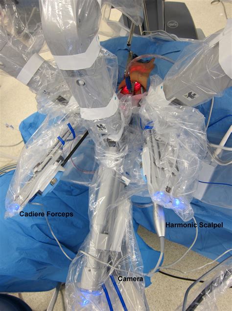 Robotic Transaxillary Total Thyroidectomy Through A Single Axillary