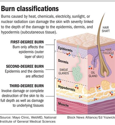 The american academy of family physicians recommends the following tips on how to treat a second degree burn: Innovative prescription for burns - The Blade