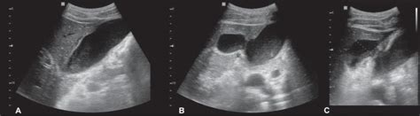 Scielo Brasil Spontaneous Perforation Of Gallbladder With