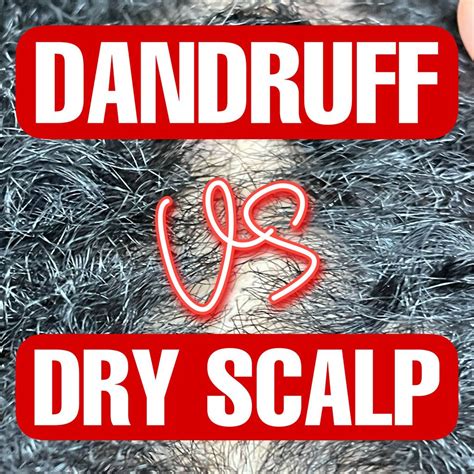 Dandruff Vs Dry Scalp What Are The Causes And Treatments Dry Scalp Vs