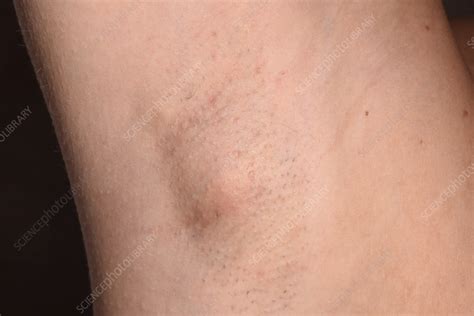 Swollen Lymph Node Stock Image C0564406 Science Photo Library