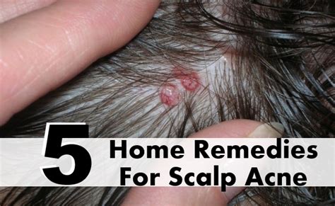5 Most Effective Home Remedies For Scalp Acne Find Home Remedy