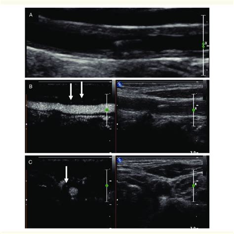 Carotid B Mode Ultrasound And Ceus In A Year Old Woman With Takayasu