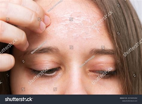 Close Up Female Forehead Peeling Skin Isolated Stock Photo 2074495492