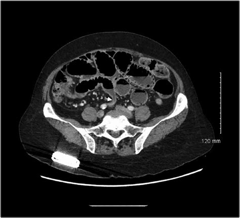 Ct Abdomenpelvis With Intravenous Contrast Showing Multiple
