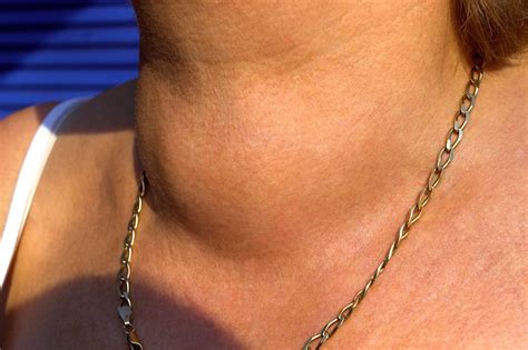 Thyroid Goiter Causes Symptoms Diagnosis Treatment And Surgery
