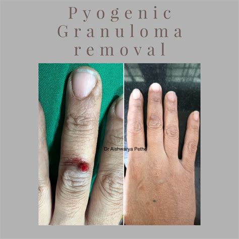 Removal Of Pyogenic Granuloma By Radiofrequency Ablation A Pyogenic